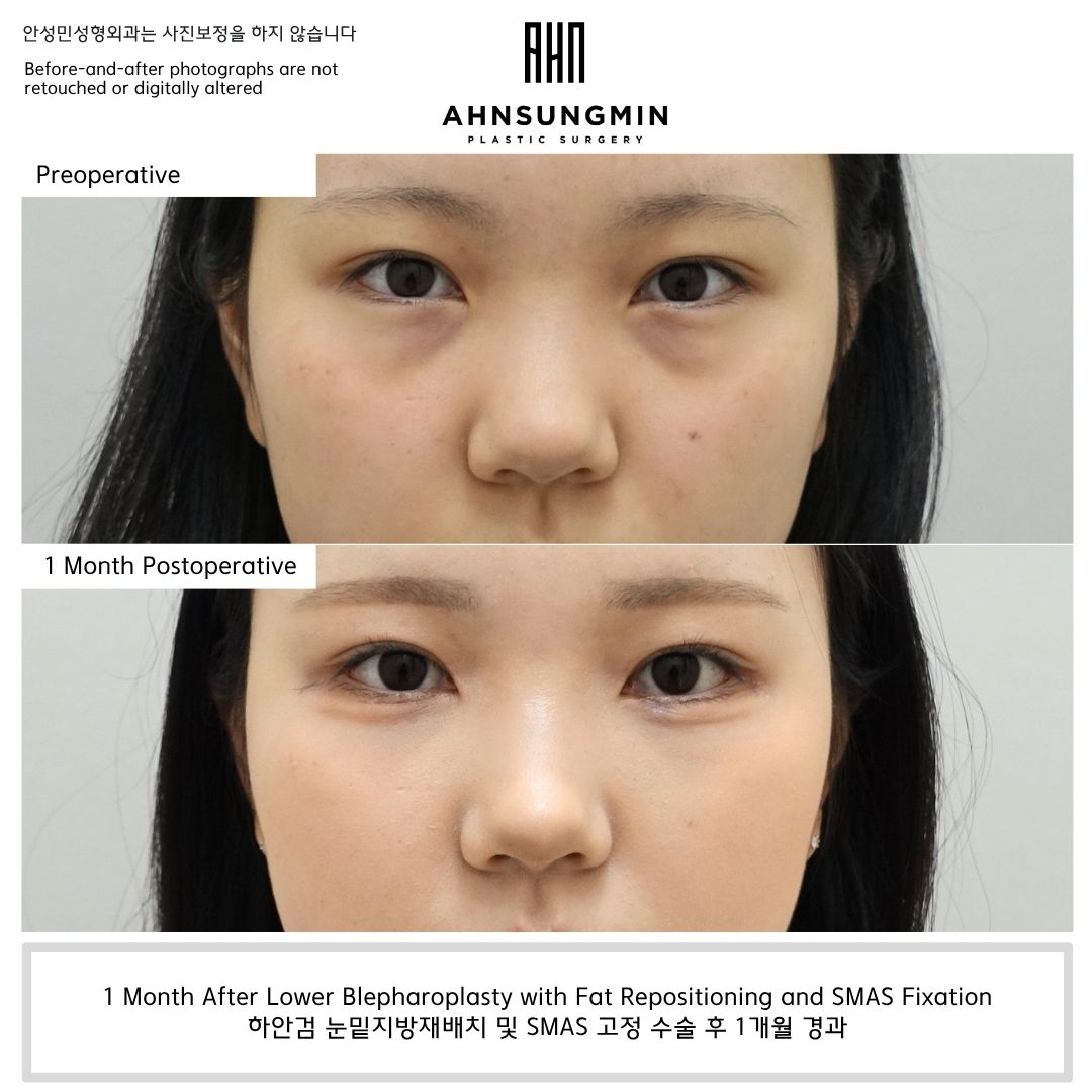 Preoperative and 1-month postoperative comparison after lower blepharoplasty with fat repositioning and SMAS fixation showing improvement in under-eye bulging and tear trough hollowing.