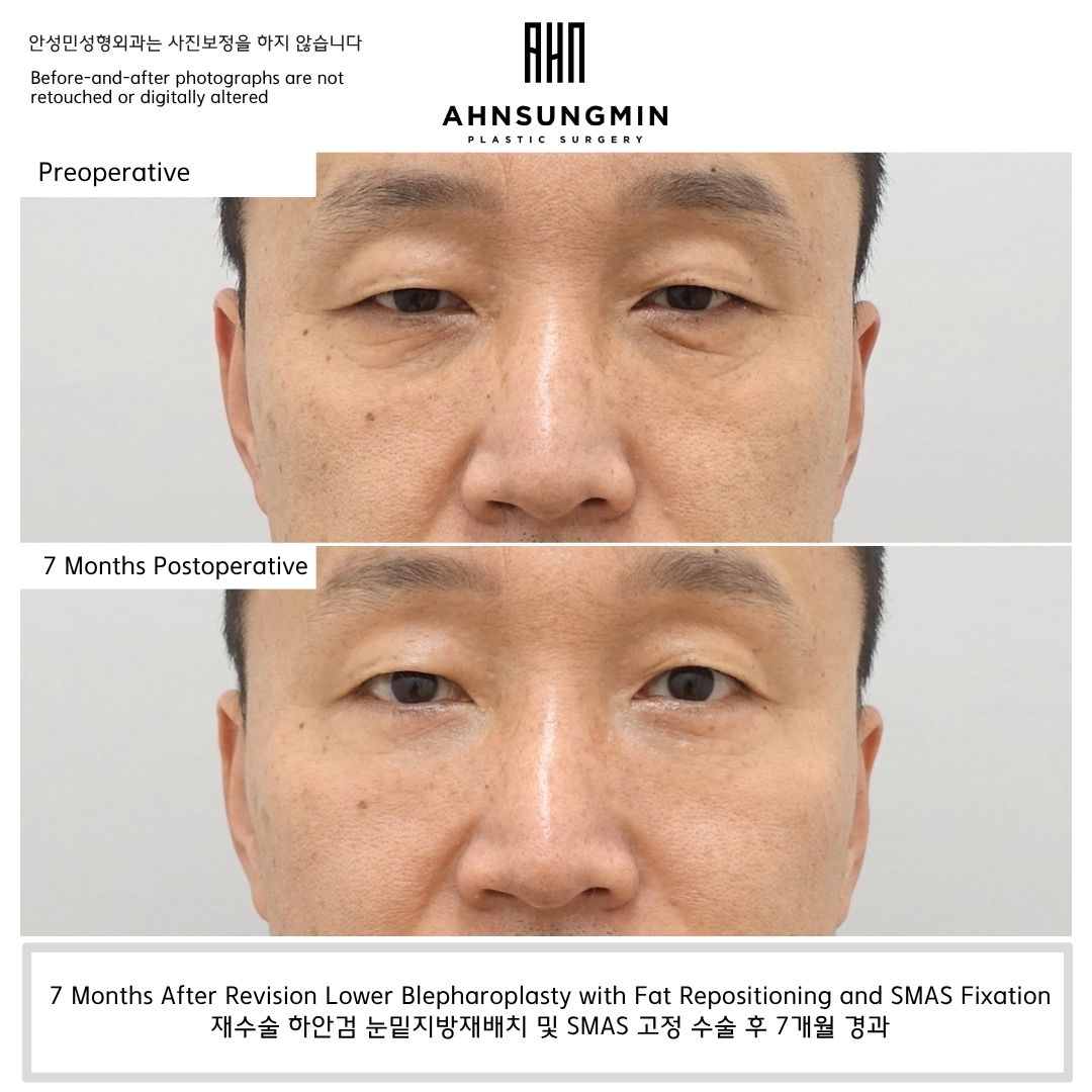 Before and 7 months after revision lower blepharoplasty with fat repositioning and SMAS fixation showing improved under-eye contour and long-term stability.